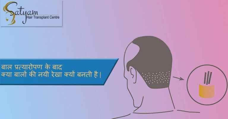 बाल प्रत्यारोपण के बाद बालों की नयी रेखा क्यों बनती है|