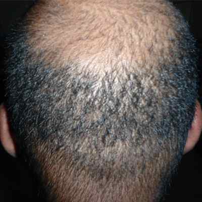 Hair Transplant Before & After