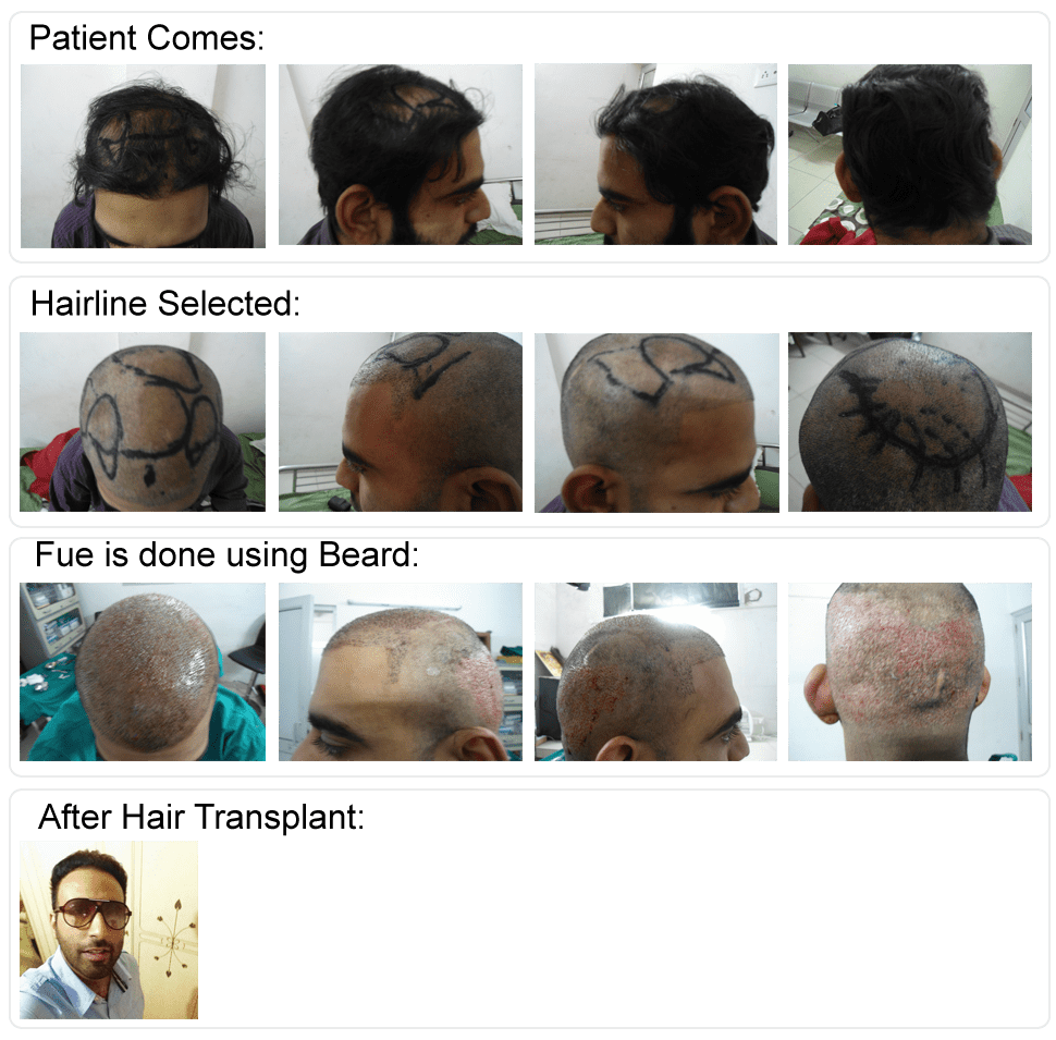 Hair Transplant Before & After