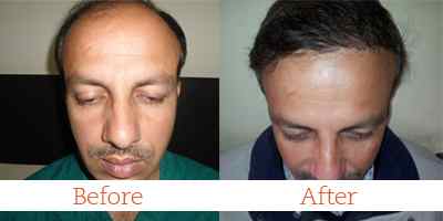 Hair Transplant in Jammu & Kashmir