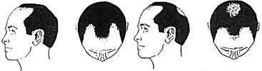 Male Pattern Baldness Treatment