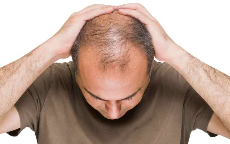 बालों के झड़ने की समस्या से छुटकारा कैसे पाएं ? जाने एक्सपर्ट्स से क्या है इसका इलाज