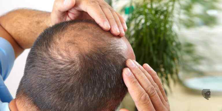 क्या कमियां आदमियों में बल झड़ने की दिकत बना सकती है ?