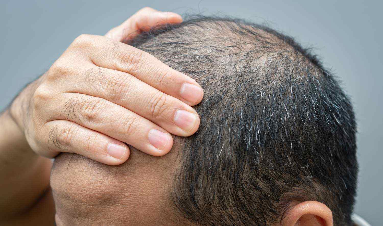 Can hair care be taken if the signs of baldness are known?