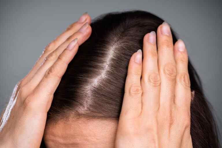 Dietary Habits To Avoid The Hair Loss