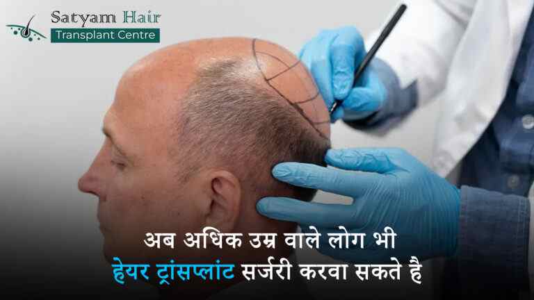 अब अधिक उम्र वाले लोग भी हेयर ट्रांसप्लांट सर्जरी करवा सकते है